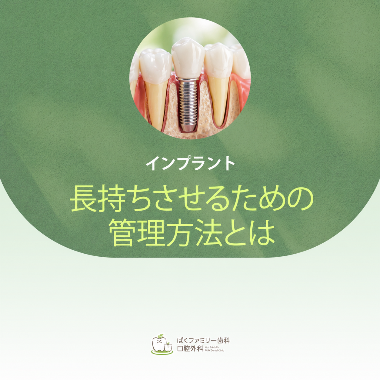 インプラント 長持ちさせるための管理方法とは