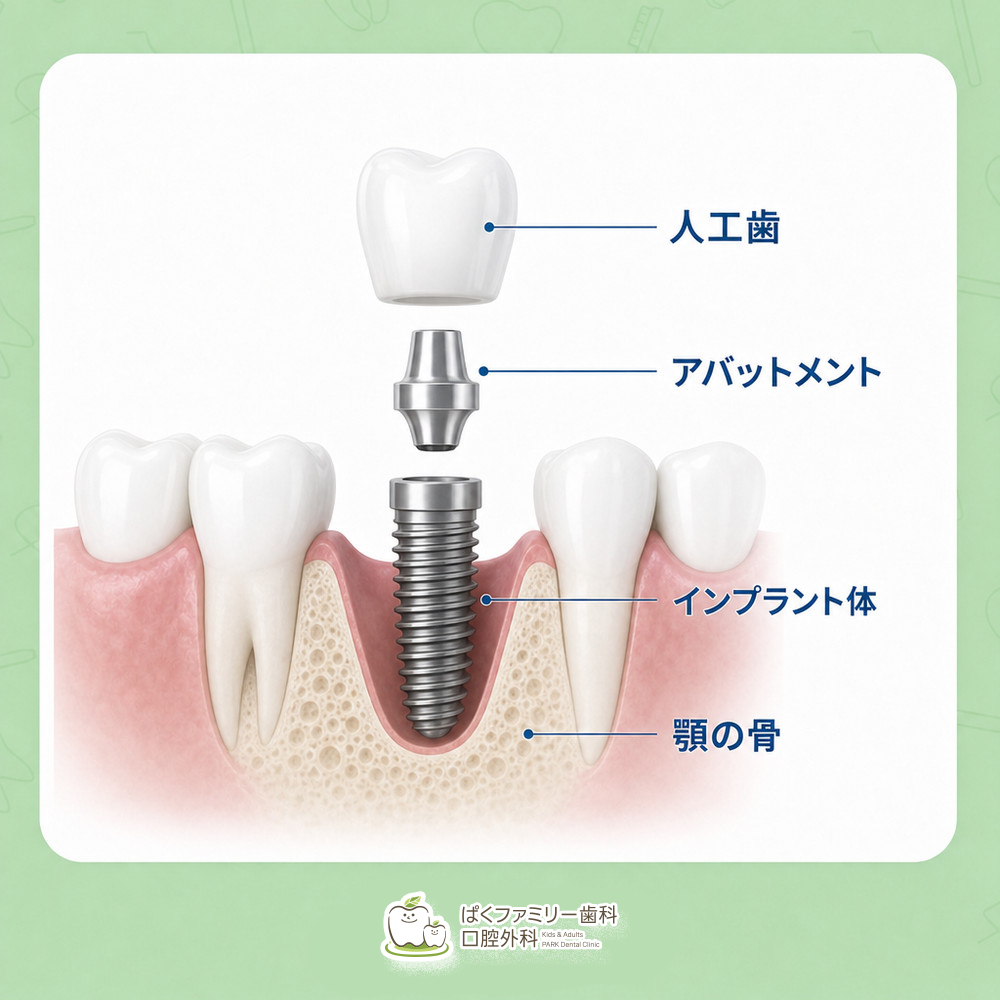 西淀川区 インプラント