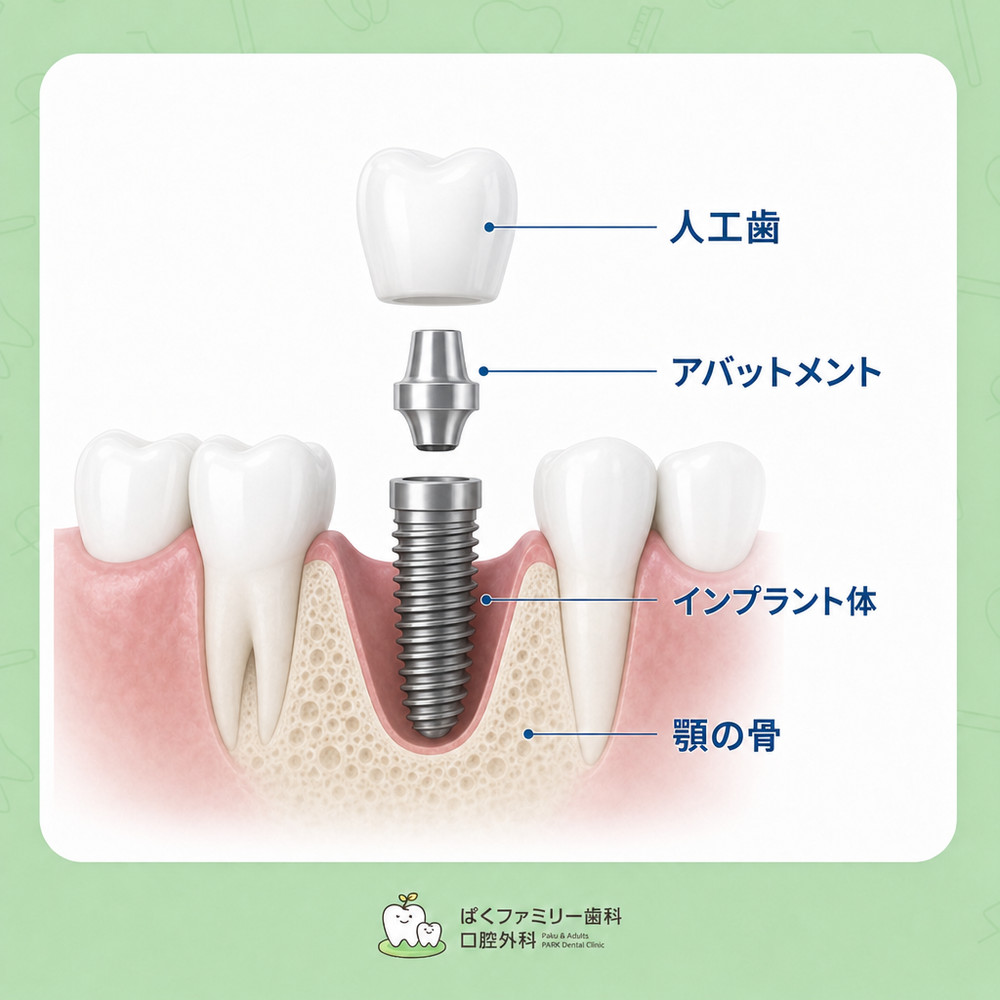 西淀川区  インプラント