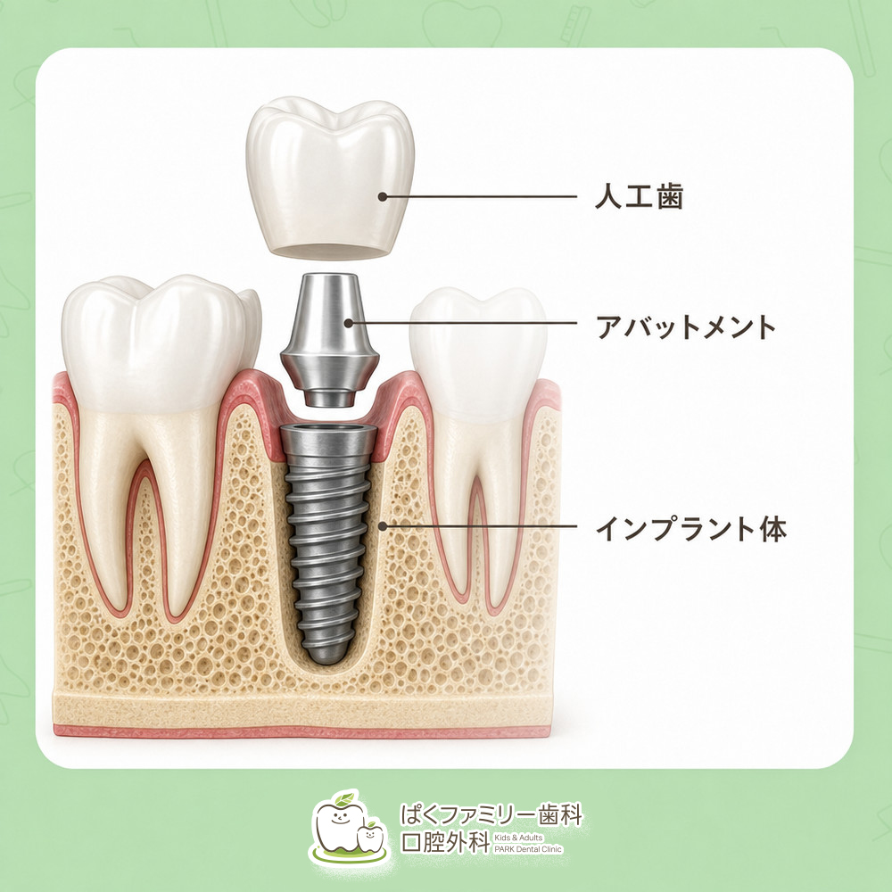 西淀川区 インプラント